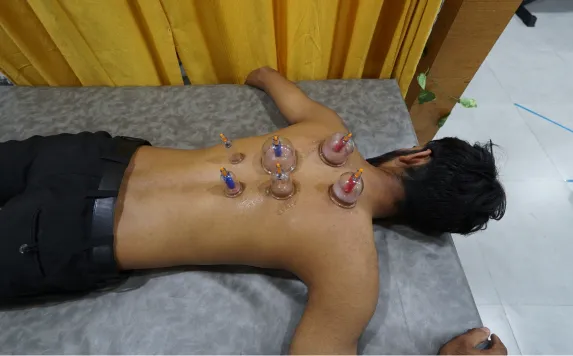 Cupping Therapy